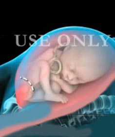 3D Medical Animation: кесарево сечение